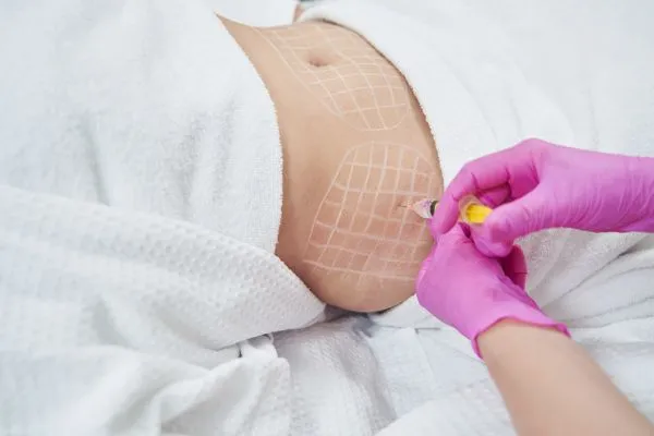 image of fat dissolving injections on love handles to help combat weight gain Whitnash
