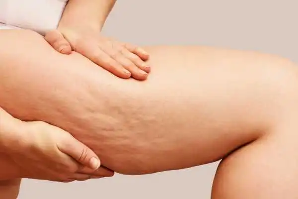 Image of woman showing leg with cellulite Whitnash