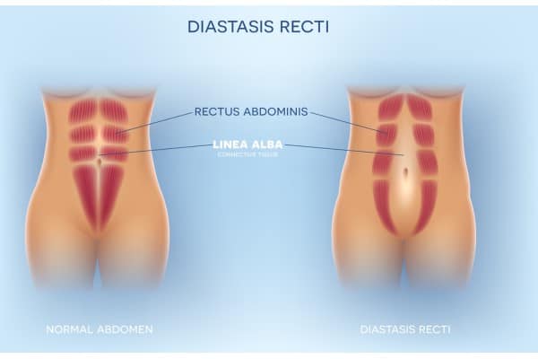 What Non-Surgical Options Are Available for Diastasis Recti Whitnash?