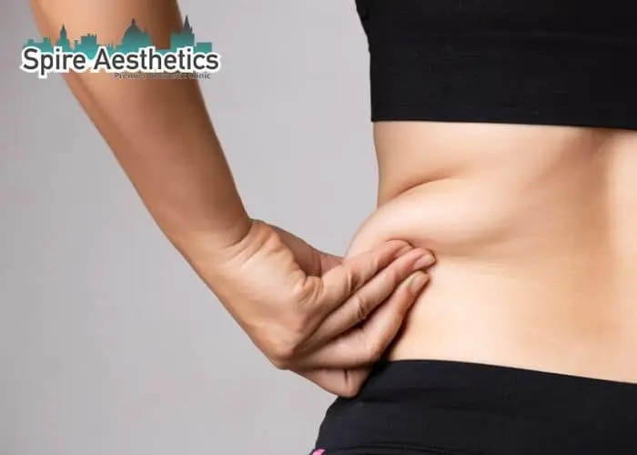 Image of woman pinching fat on their hips Whitnash. Fat Freezing treatment