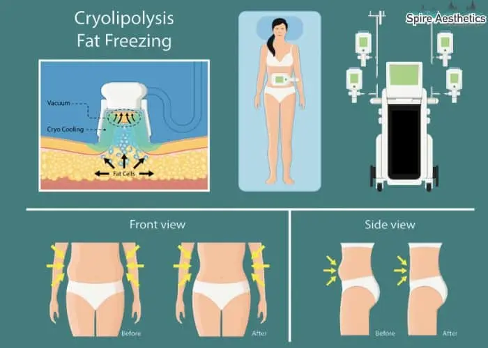 Fat freezing treatment Whitnash benefits for competitions to remove stubborn fat deposits.
