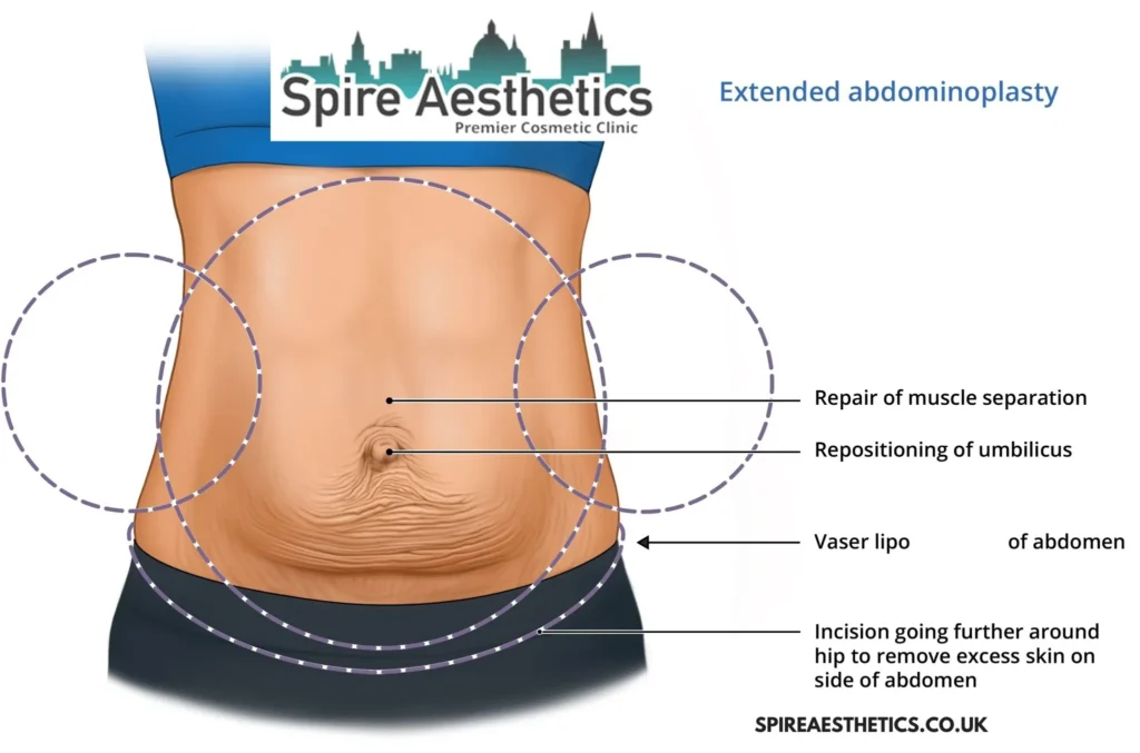 Understanding Loose Skin After Gastric Band Whitnash Surgery and HIFU Treatment
