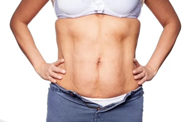 sagging skin on woman's stomach after weight loss injections Whitnash
