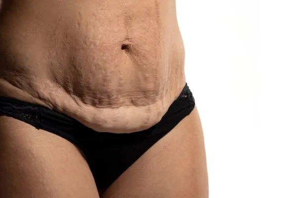 Image of womans stomach after weight loss injections Whitnash showing saggy skin
