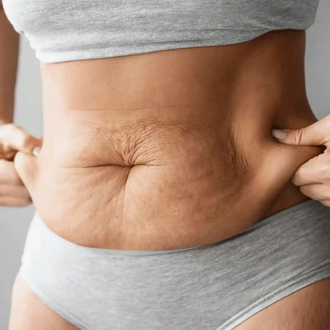 Is It Normal to Have Loose Skin After Pregnancy Whitnash?