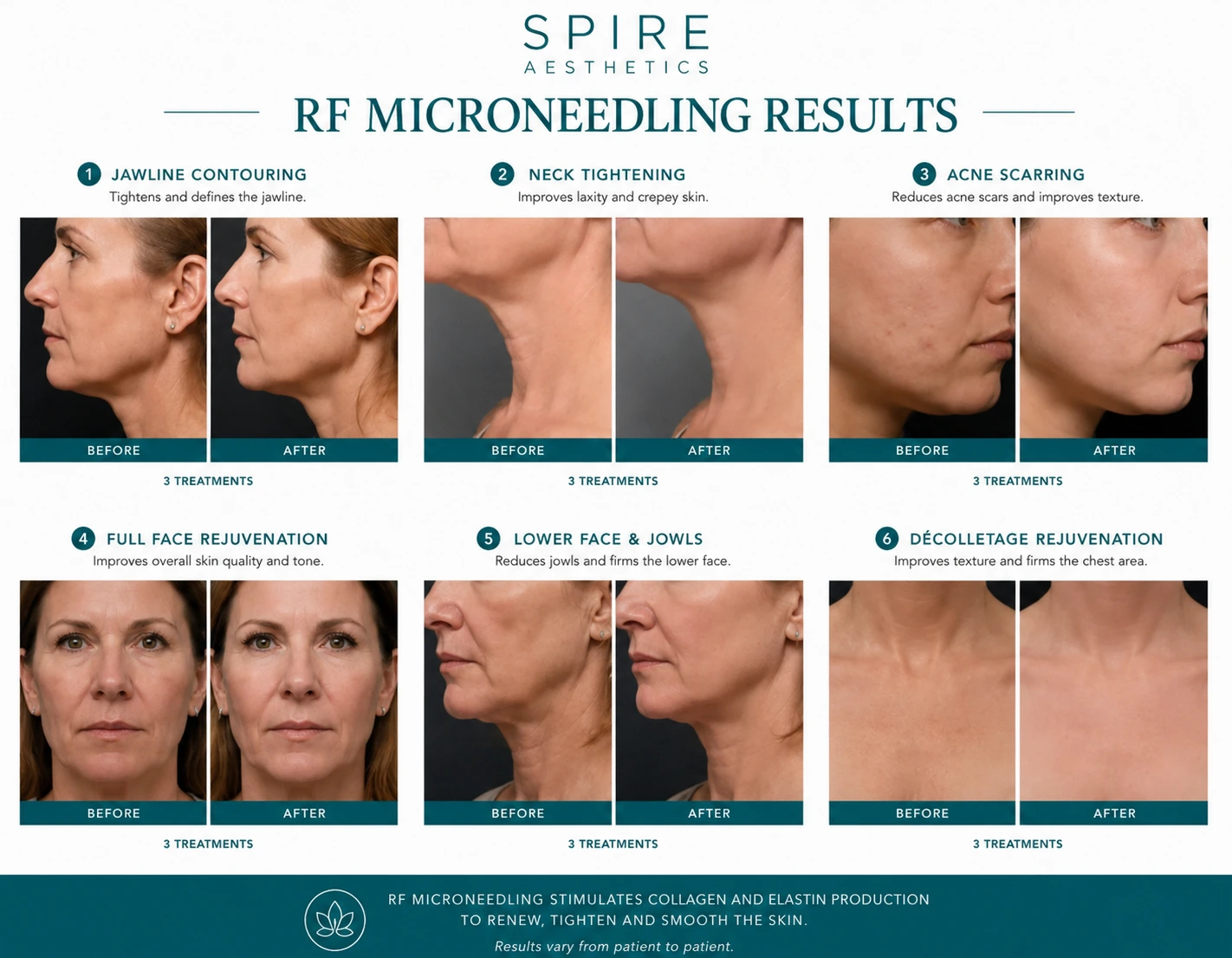 RF Microneedling Skin tightening Whitnash results