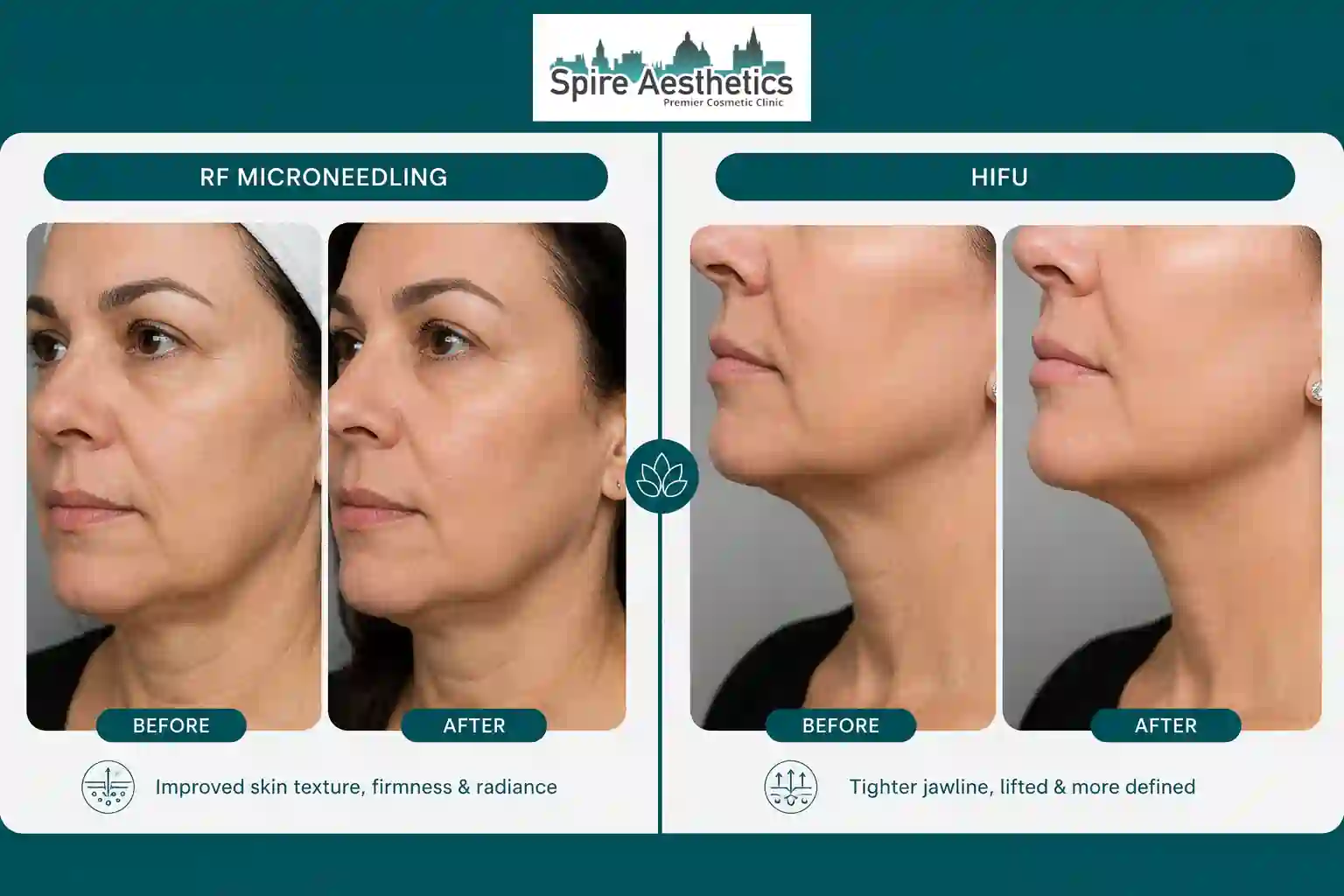 Can RF Microneedling and HIFU Be Combined Whitnash?