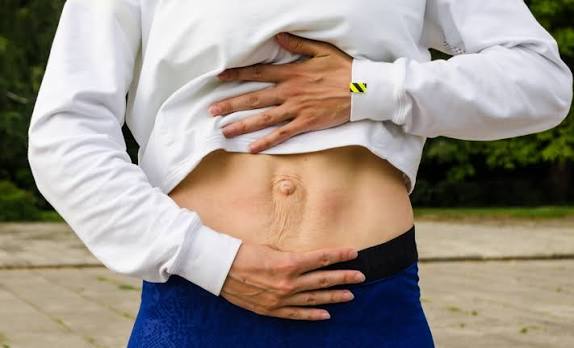 When Could Diastasis Recti Be the Missing Piece of the Puzzle Whitnash?