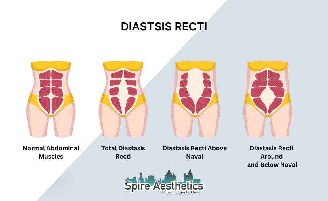 Is Non-Surgical Diastasis Recti Treatment Right for You? Common Concerns Answered Whitnash